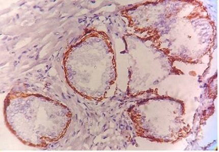 Diagnostic and prognostic role of Ki-67 and cytokeratin-5 expression in BPH and carcinoma prostate