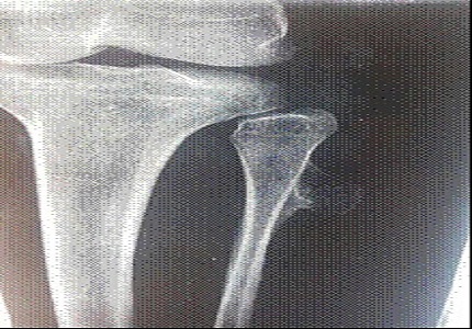Proximal fibular osteochondroma causing splitting of common peroneal nerve leading to neuropathy in an adult – a rare case report