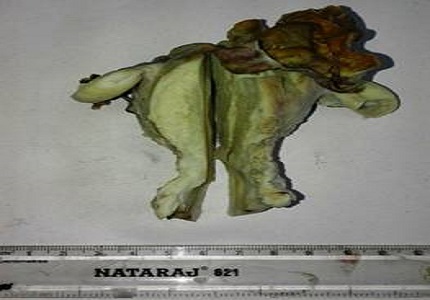 Cystic endosalpingiosis of the uterus-a rare entity in disguise