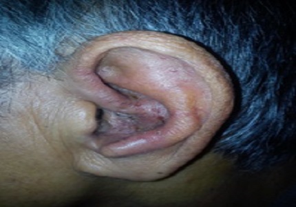 Herpes zoster oticus with multiple cranial nerve involvement: a rare presentation