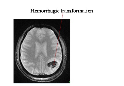 Multiple cerebral venous sinus thrombosis in a young male presenting as Status epilepticus