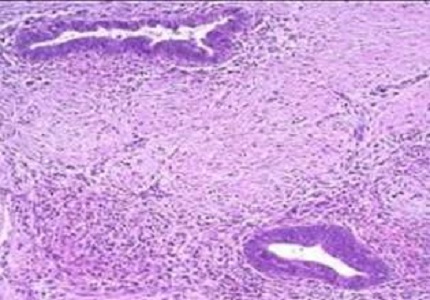 A rare case of primary umbilical endometriosis in a nulliparous female confirmed on imaging and histopathology: Case report