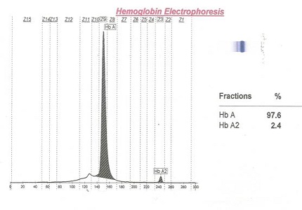 A Clinico-Haematological study of hemoglobin E disease and trait