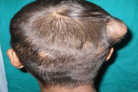 Epidemiological study of Appendageal skin tumors in tertiary health centre in central India