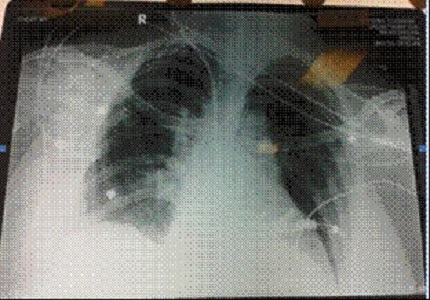 Entrapment of pulmonary artery catheter in superior vena caval cannulation site during cardiac surgery
