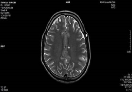 Extensive disseminated cysticercosis with involvement of all possible rare sites in a single patient – MRI and USG diagnosis