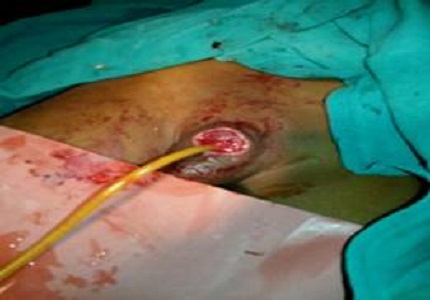 A rare complication seen in a child diagnosed with acute lymphoblastic leukemia: Isolated penile gangrene