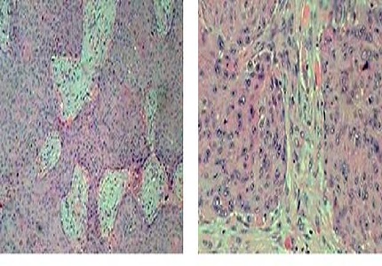 Cutaneous Metastasis of Esophageal Squamous Cell Carcinoma (ESCC)