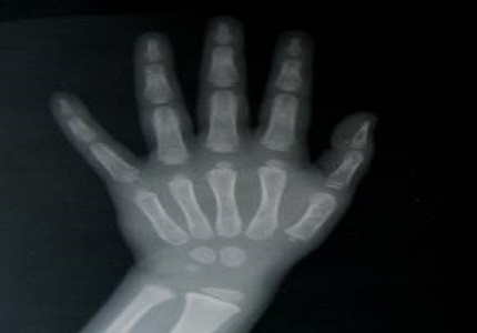 Skeletal Maturation in the pediatric population in a large tertiary care hospital in South India