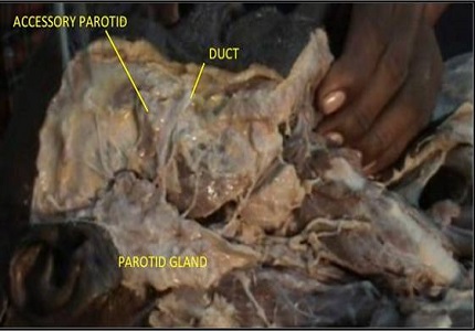 Accessory parotid gland: its surgical importance
