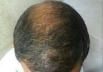 Acneform eruptions with use of minoxidil-a case report