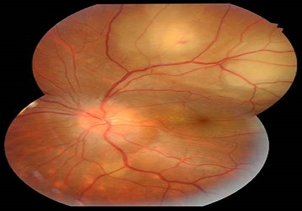 A rare case of tuberculous choroidal abscess