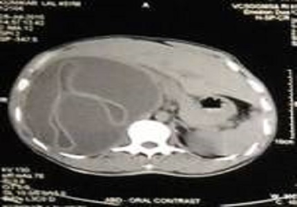 Hydatid cyst-our institutional experience in hill area of Uttarakhand