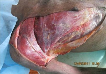 Cadaver dissection study of the pectoral nerves for feasibility in brachial plexus injuries