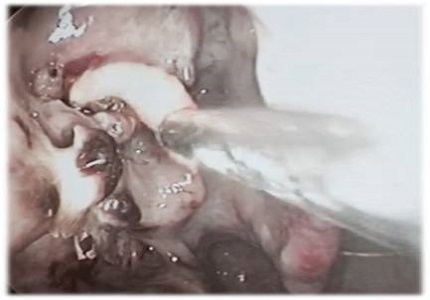 Nasal leprosy: an ancient disease not to be forgotten