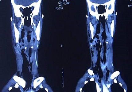Spontaneous cervical emphysema: a challenge in establishing a plausible etiology