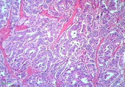 Insulinoma with seizures – a rare presentation of a rare tumour