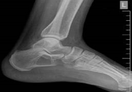 Intraosseous lipoma of the calcaneum