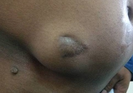 Drain Site Hernia in Adult - Case Report and Review of Literature
