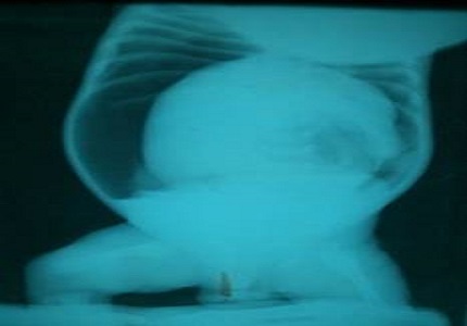 Rare case of gastric perforation with malrotation and volvulus: A case report