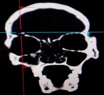 Supraorbital rim fracture caused by Intra-orbital foreign body: A case report