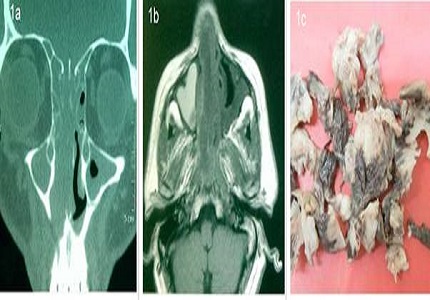 Sinonasal Teratocarcinosarcoma