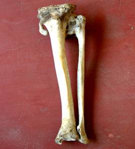 Proximal Tibiofibular Synostosis and its Clinical Significance: A Case Report