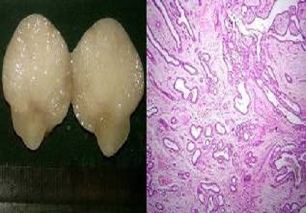 Histopathological study of breast lesions