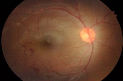 Role of antituberculous therapy in Eales disease