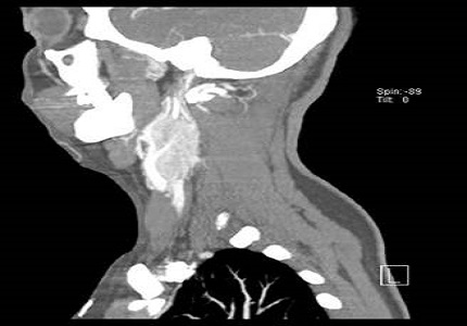 Asymptomatic bilateral chemodectomas: a masquerader of simple neck masses