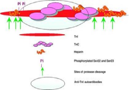 hsTropI: an early biomarker of acute coronary syndrome & MI