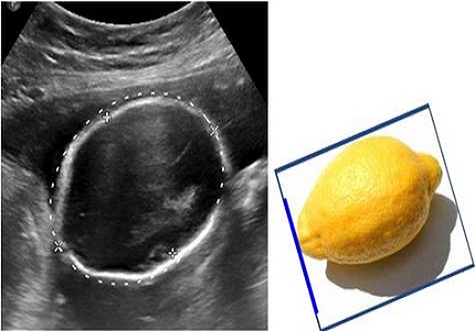 Prenatal sonographic evaluation of Arnold Chiari II Malformation