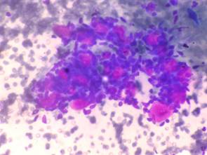 Basal cell adenoma mimicking adenoid cystic carcinoma on FNAC- A Case Report