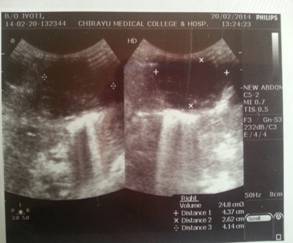 Hepatic Abscess in Preterm Newborn- A rare entity
