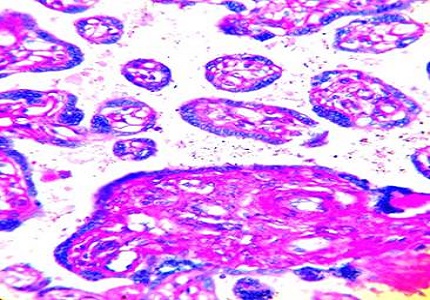 Can diabetes with controlled glycemic status cause placental changes and affect foetal outcome? A histomorphology study from a tertiary care centre from Eastern India