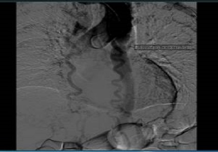 Coarctation of aorta presenting as hypertensive encephalopathy in a young female