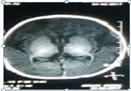 A rare case of familial methylmalonic acidemia presenting with Acrodermatitis Enteropathica type of lesion
