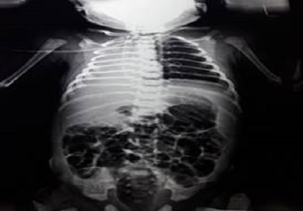 Unilateral Pulmonary Agenesis – As a cause of respiratory distress in newborn