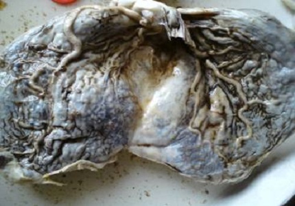 Study of arterial pattern of normal human placenta in reference to its shape, weight and Hyrtl’s Anastomosis