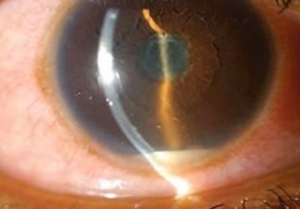 Clinical study on efficacy of infliximab on severity and occurrence of acute anterior uveitis in HLA-B27