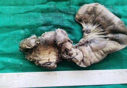 Role of ca 19-9 as a tumor marker in diagnosis and prognosis of pancreatic carcinoma and cholangiocarcinoma (A study of 46 cases)