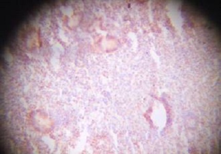 Altered PTEN expression as a diagnostic marker for the earliest endometrial precancerous changes