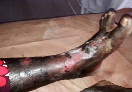 Methotrexate Induced Toxic Epidermal Necrolysis: A Case Report