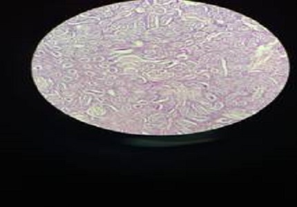 Case report of sertoli-leydig cell tumor of bilateral ovaries in a woman with 46XYkaryotype
