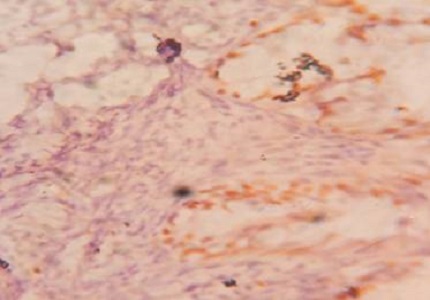Expression of estrogen receptor, progesterone receptor and KI 67 in epithelial ovarian tumors and their histopathological correlation