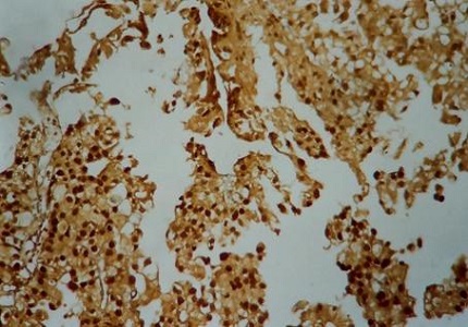 Prognostic value of P53 nuclear overexpression in bladder cancer