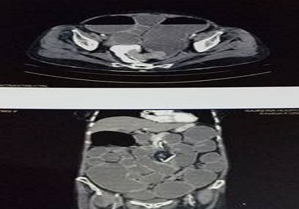 Role of imaging in evaluation of intestinal obstruction