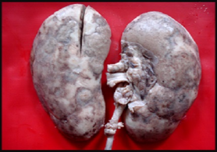 Renal cortical necrosis at autopsy: a 12 year experience at a tertiary care centre in Mumbai
