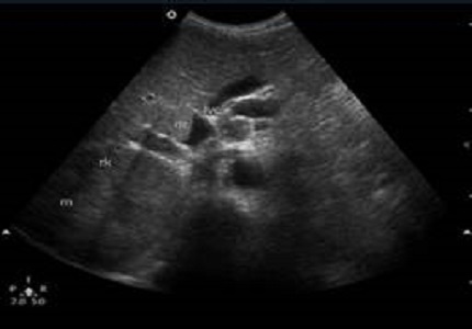 Imaging evaluation of renal masses