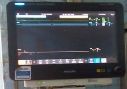 Unusual near- miss case of atonic postpartum haemorrhage in GMC Chandrapur (Dawn from death to life)